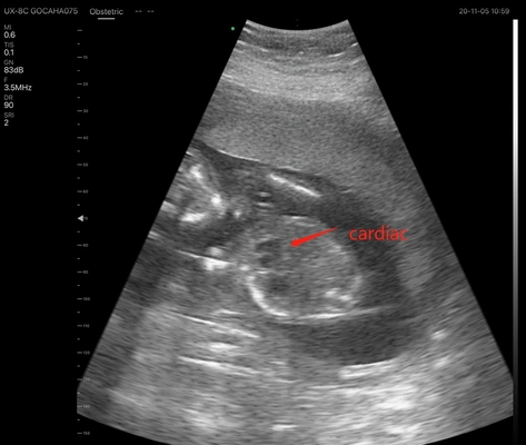 Linear/Convex/Phased Array 3 in 1 Handheld USB Ultrasound Double Probes Wireless Color Doppler Scanner