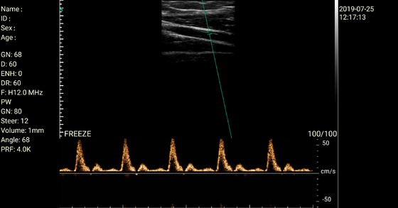 Wireless Linear Probe High Frequency Probe Special Tool for Visual Puncture Guidance Integrated Handheld Ultrasound Scanner