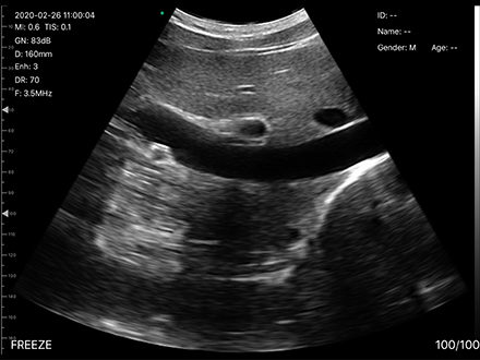 USB Convex Ultrasound Transducer Wireless Convex Array Ultrasound Probe for OB/GYN Lung Urology Application