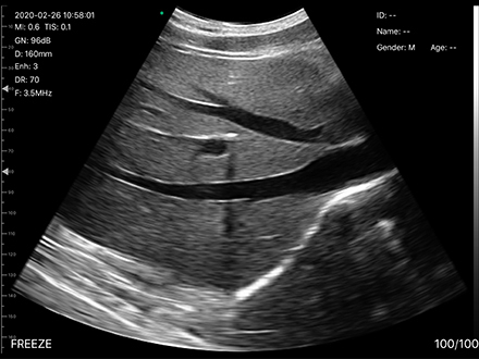 USB Convex Ultrasound Transducer Wireless Convex Array Ultrasound Probe for OB/GYN Lung Urology Application